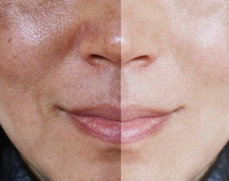 Arbutin White® - Crema Aclarante Facial